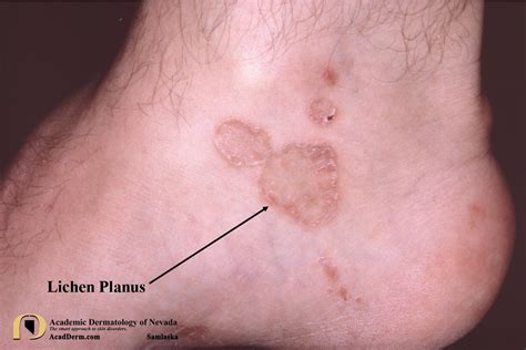 Lichenplanus4samlaska Academic Dermatology Of Nevada