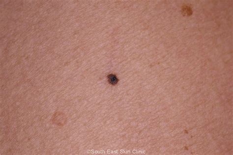 Mole Nevus South East Skin Clinic