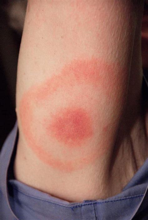 Lyme Disease Symptoms And Prevention
