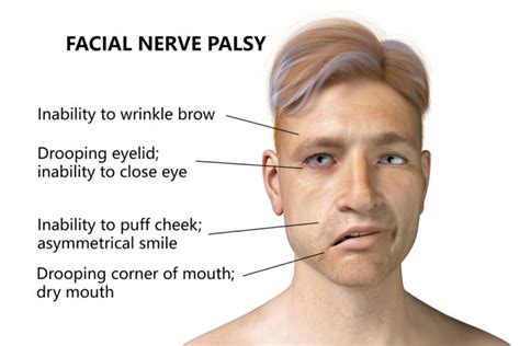 Bell S Palsy Causes Symptoms And Treatment Casey Optical Too Blog