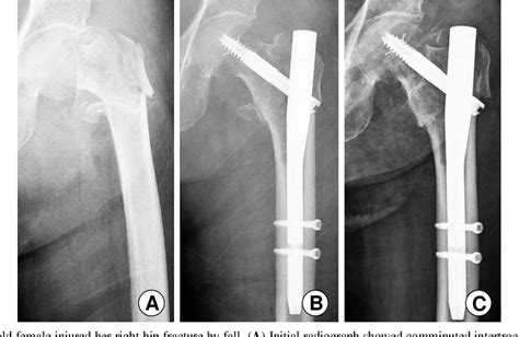 Figure 1 From Treatment Of Intertrochanteric Fracture Of The Femur