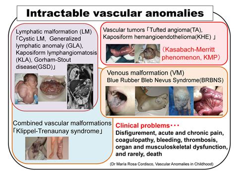 Refractory Vascular Anomalies Tumorsmalformations ｜ Society Of The