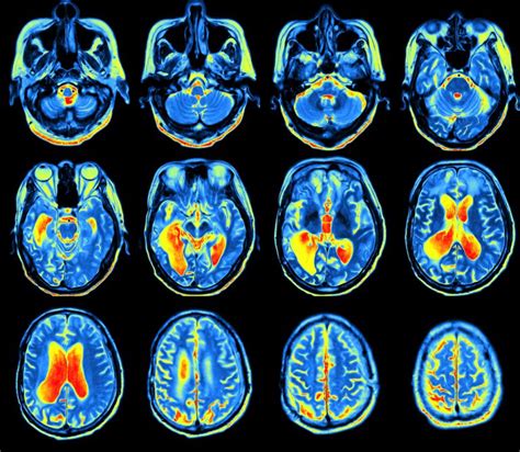 Fdg Pet Scan More Accurately Assesses Severity Of Cognitive Decline In