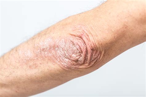 Acute Psoriasis On The Elbows Of A Man Is An Autoimmune Incurable