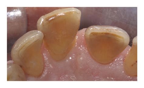 Maxillary Right Central And Lateral Incisors Before Extraction A