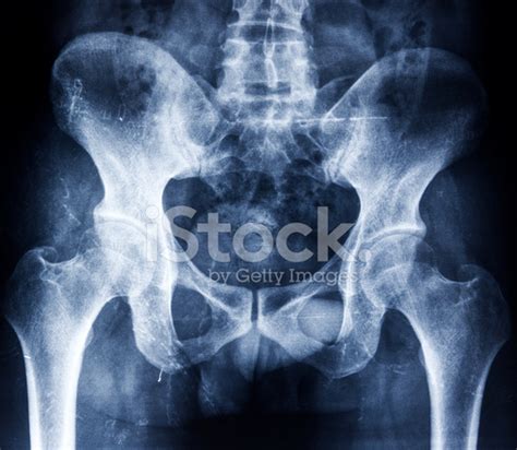 Human Pelvis X Ray Stock Photos
