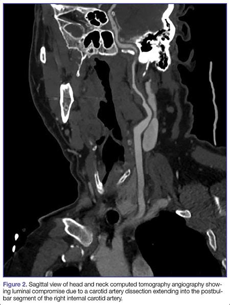 A Spontaneous Internal Carotid Artery Dissection Presenting With