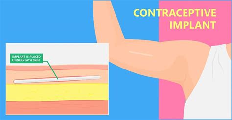 10 Reasons Why Implanon May Be The Best Birth Control Method For Working Couples Dr Ben