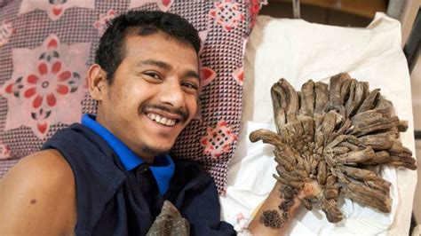 Bangladeshi ‘tree Man Reportedly Back In Hospital With More Growths