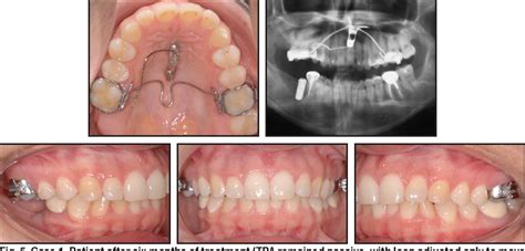 Figure From Upper Molar Intrusion Using Anterior Palatal Anchorage And The Mini Mousetrap