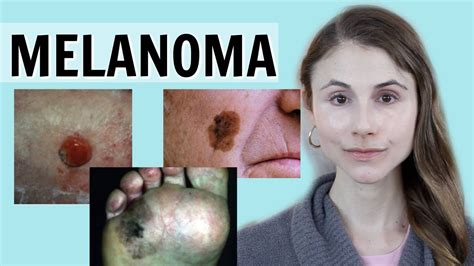 Melanoma Skin Cancer Qanda With Dermatologist Dr Dray Youtube