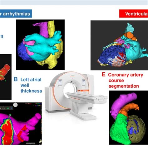 Usefulness Of Cardiac Magnetic Resonance Cmr For Catheter Ablation Of