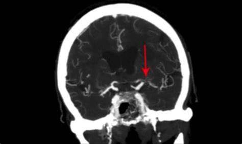 CT Angiogram Demonstrating Left Middle Cerebral Artery Stenosis Download Scientific Diagram