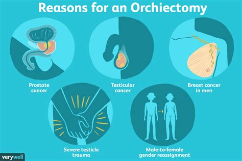 Orchiectomy Why Its Done And Possible Side Effects