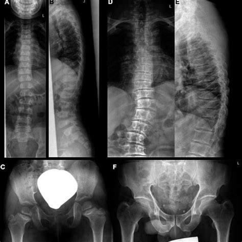 Spondylo Metaphyseal Dysplasia Kozlowski Type Smdk Both Smdk