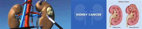Kidney Cancer Surgery And Treatment Total Nephrectomy Treatment For