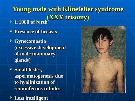 Klinefelter Syndrome Celebrities With Turner Syndrome Klinefelter