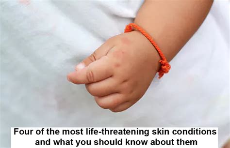 Four Of The Most Life Threatening Skin Conditions And What You Should
