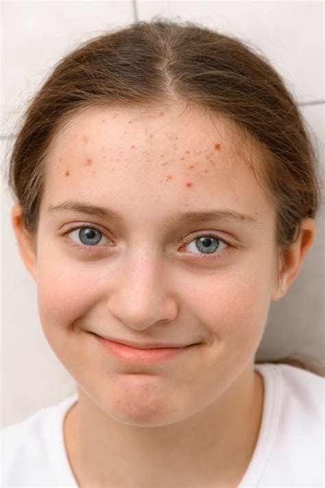 Face Of A Teenage Girl With Pimples Acne On The Skin Portrait Of A