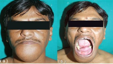 Preoperative External Appearance Of Lower Jaw Swelling A Frontal