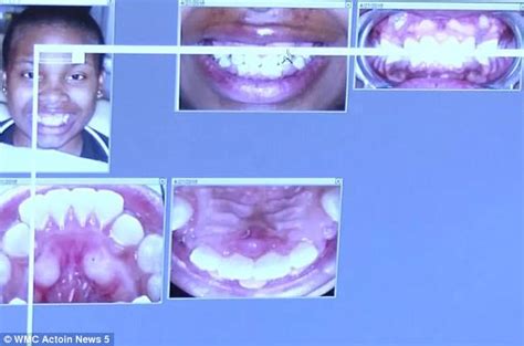 Tennessee Teens Allergy To Braces Almost Killed Her Daily Mail Online