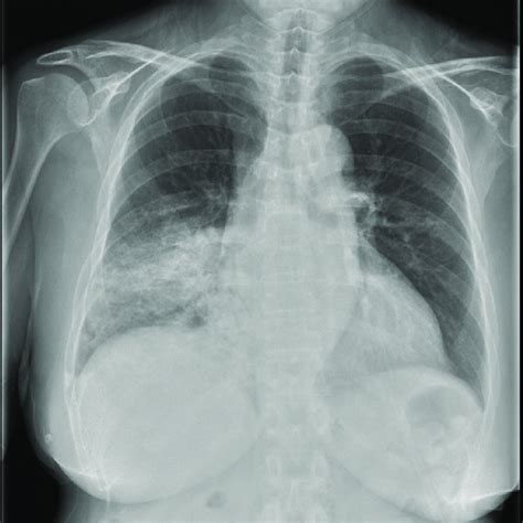 Chest Radiograph At Admission Showed Ill Defined Patchy Consolidation