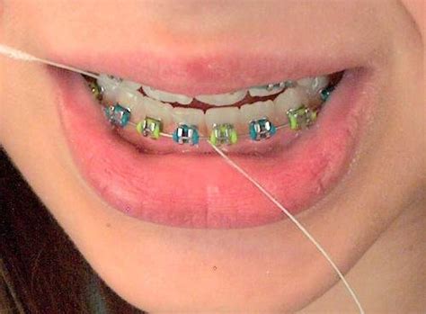 Contextual translation of karang gigi into english. Dental Floss: Mencegah Timbulnya Karang Gigi - drg. Dio Nella