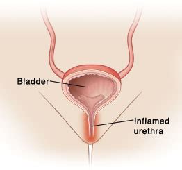 The female urethra is short compared to the male urethra. Krames Online - Urethritis in Women