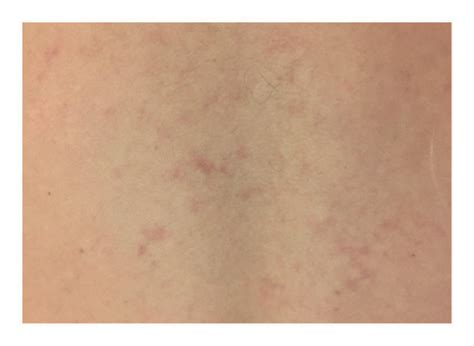 Lacy Purplish Rash On The Upper And Lower Back Download Scientific