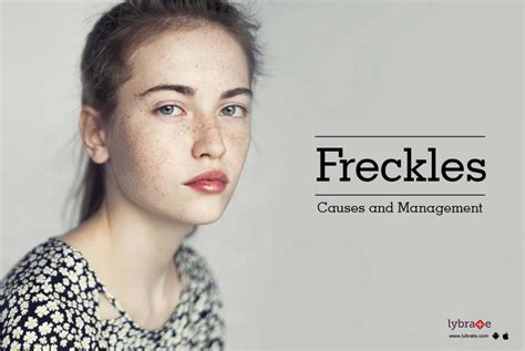 Freckles Causes And Management By Dr Nivedita Dadu Lybrate