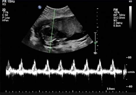 Fetal Heart With Doppler Heartbeat Waveform Showing A Normal Cardiac