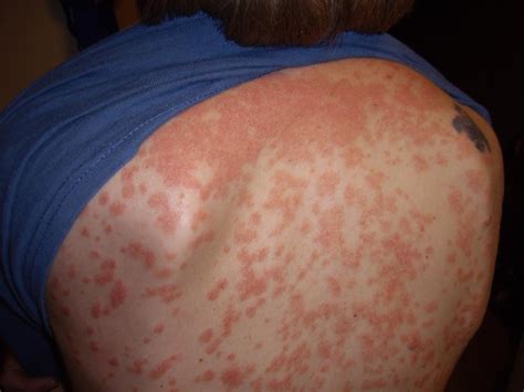 Guttate Psoriasis Causes Symptoms And Treatment Medical News Today