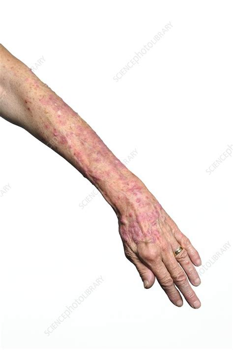 Psoriasis On The Arm Stock Image C0103337 Science Photo Library
