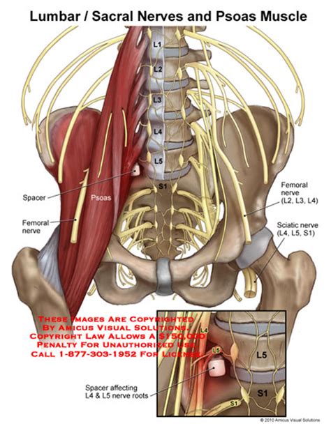 Amicus Illustration Of Amicusinjurylumbarsacralnervespsoasmuscle