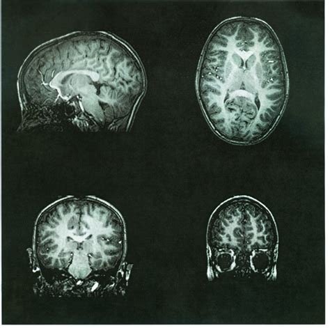 Measuring Brain Tissue Damage Accurately Identifies Cognitive Decline