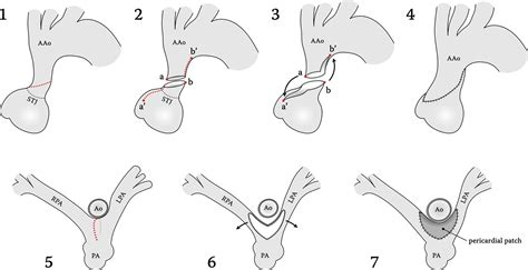 Sliding Aortoplasty For Severe Supravalvular Aortic Stenosis After The Lecompte Procedure The