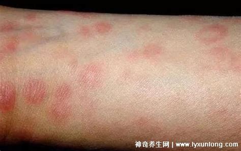 初期梅毒疹图片症状，躯干上的斑疹皮疹脓疮蔓延至手脚心 — 神奇养生网