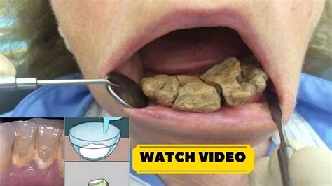 Remove Teeth Plaque And Tartar At Home Naturally Fast And Easily How