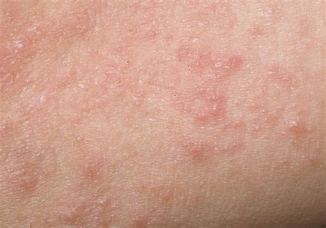Can Eczema Cause Little Bumps