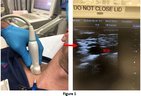 The Supraclavicular Subclavian Sinaiem