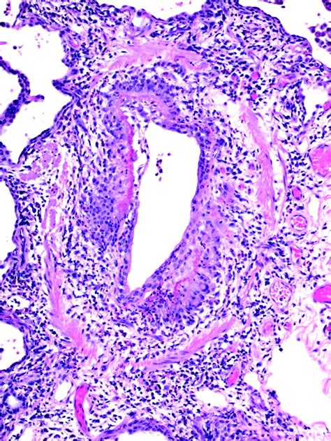 Histological Appearances Of Putative Montelukast Related Churgstrauss
