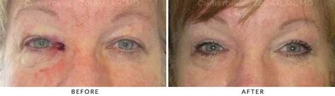 Skin Cancer On Eyelid Symptoms