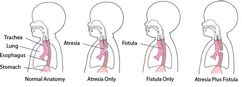 Esophageal Atresia And Tracheoesophageal Fistula Childrens Health