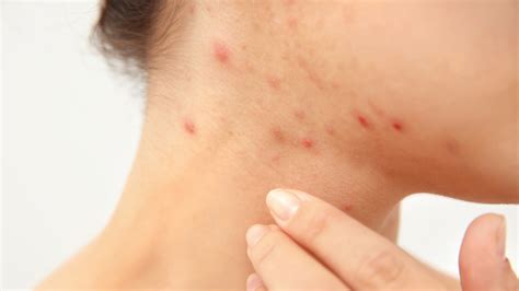 What You Dont Know About Pimples