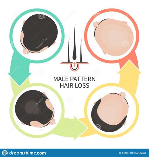 Male Pattern Baldness Four Steps Infographics Template Stock Vector