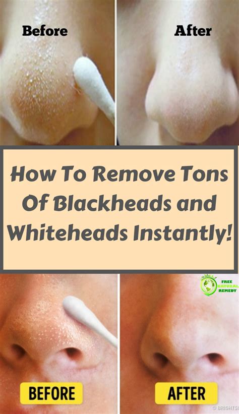 How To Get Rid Of Nose Blackheads Home Remedy Howotremvo
