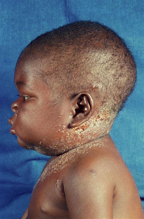 A variety of infections caused by herpes simplex virus types 1 and 2. Aids Baby With Herpes Photograph by Dr M.a. Ansary/science ...