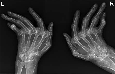 Rheumatoid Arthritis Hands Radiology At St Vincent S University Hospital