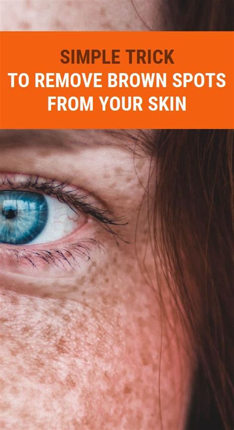 Simple Trick To Remove Brown Spots From Your Skin Brown Spots On Face