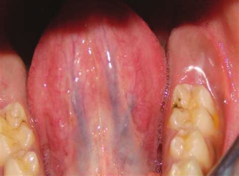 Pathology Outlines Odontogenic Cysts Eruption Cyst